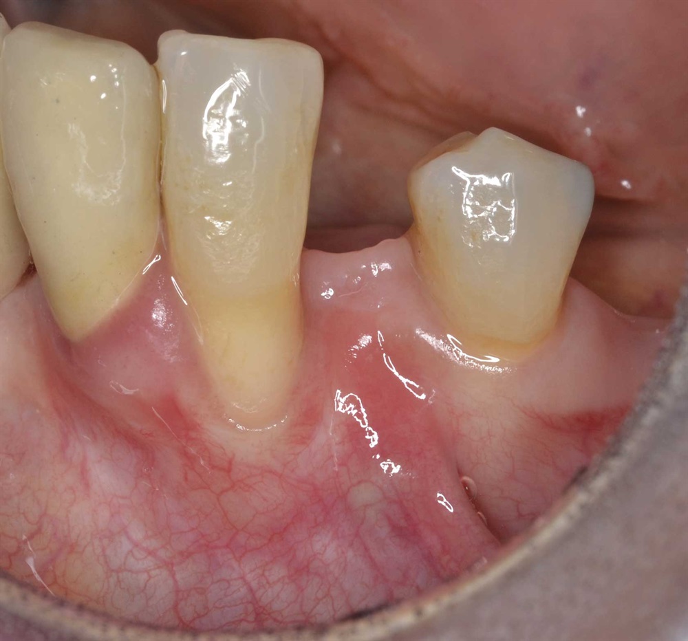 Tarquini_Periodontal intrabony defect